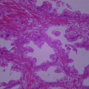 738D - Préparation microscopique du cancer de la prostate