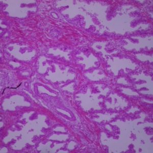 738D Cancer prostate x40