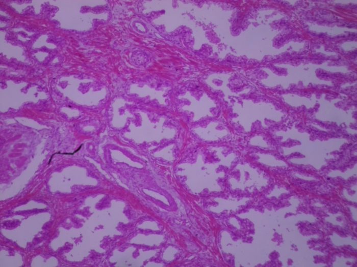 738D Cancer prostate x40