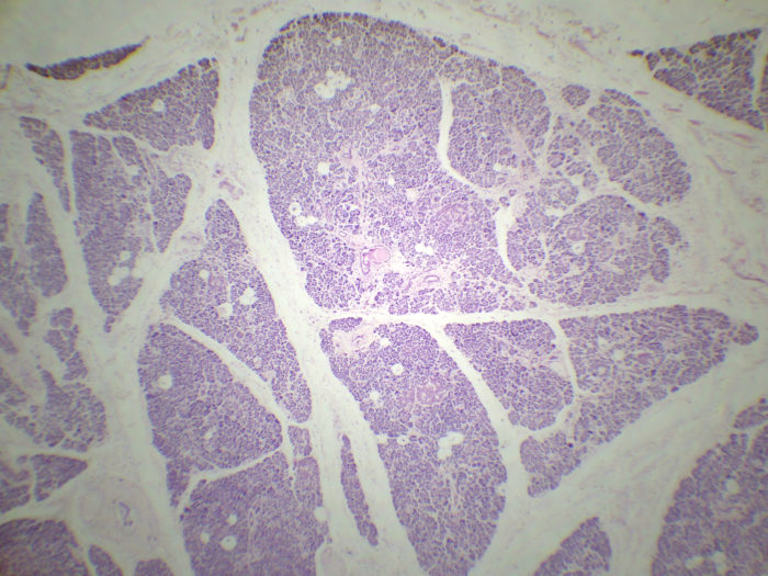 Pancréas Diabétique