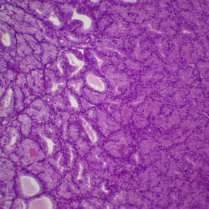 Thyroïde hyperactive