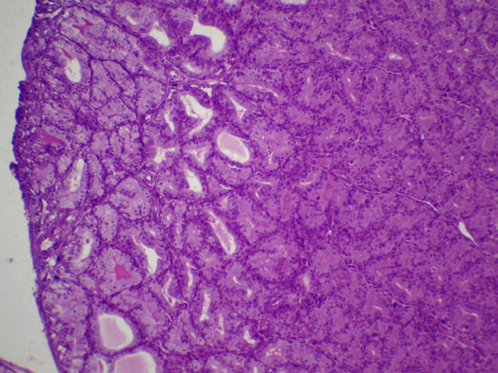 Thyroïde hyperactive