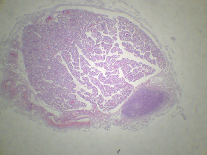 Thyroïde et Parathyroïde CT