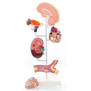 hypertension