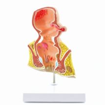 rectum, modèle avec pathologies