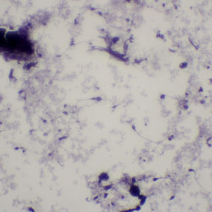 spermatozoïdes pathologiques