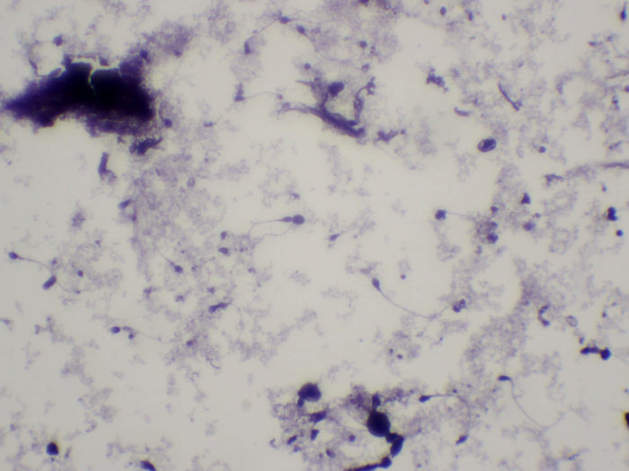 spermatozoïdes pathologiques