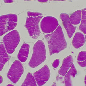 glycogène dans le muscle CT