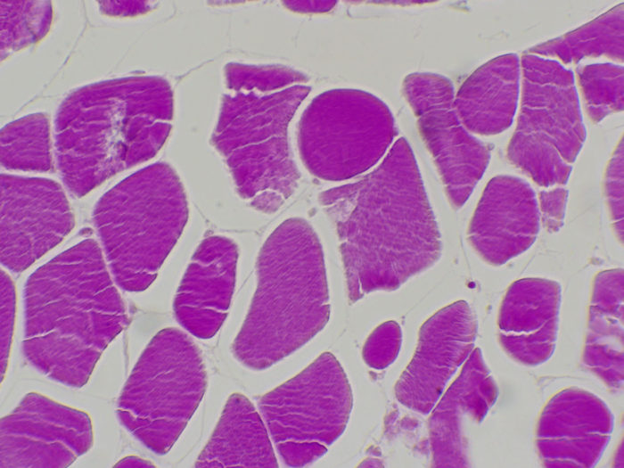 glycogène dans le muscle CT